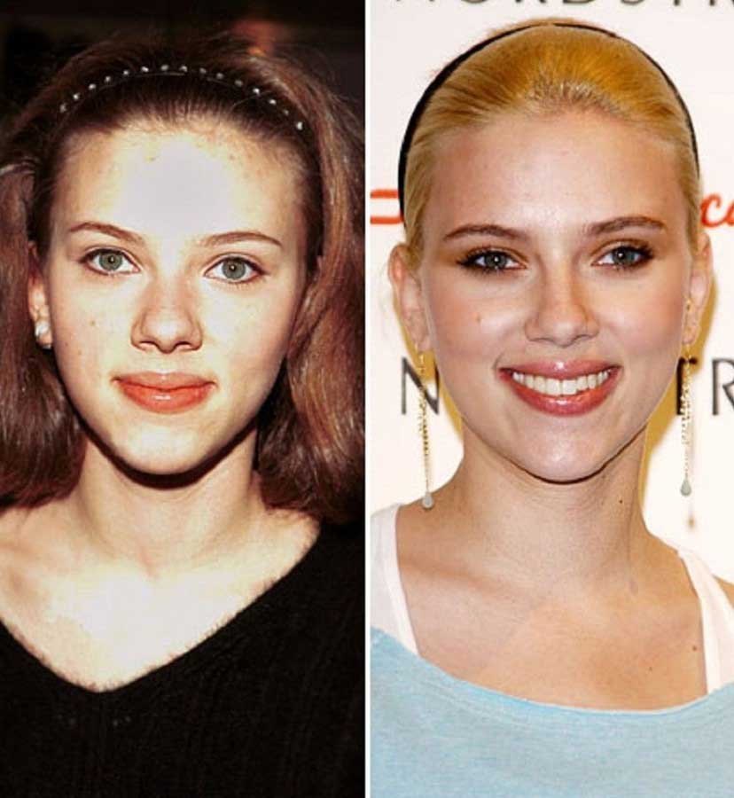 Scarlett Johansson Plastic Surgery – A Perfect Beauty Transformation