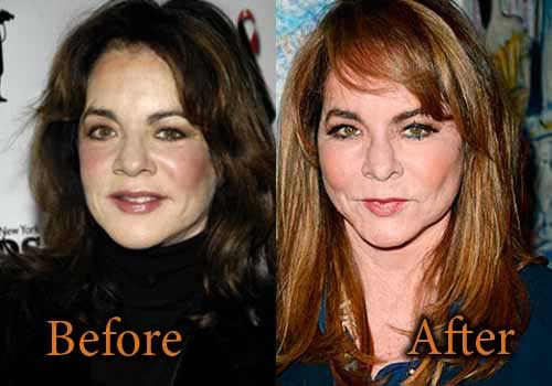 Stockard Channing Beauty Enhancement – Good or Bad Result?