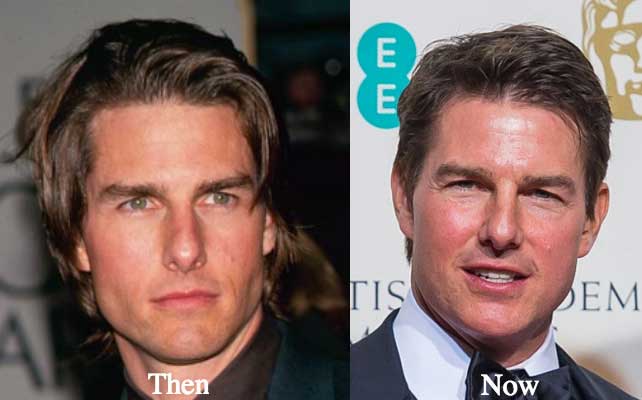 Tom Cruise Plastic Surgery Get Painful Results