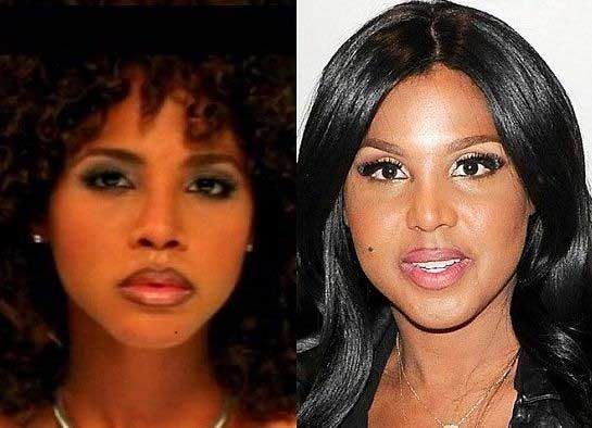 Did Toni Braxton Have Plastic Surgery?