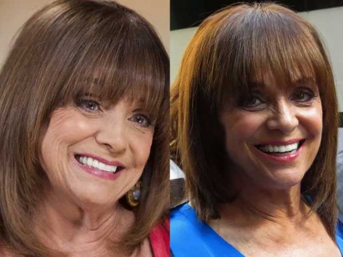 How Valerie Harper Get Many Benefits From Plastic Surgery?